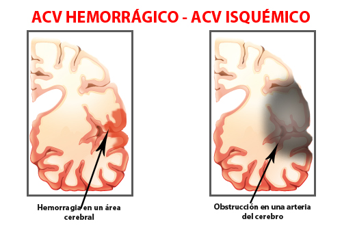 ACV – En la Argentina hay 1 cada 4 minutos