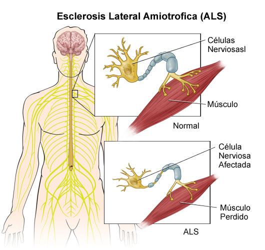 Importante charla informativa sobre “ELA” (Esclerosis Lateral Amiotrófica).