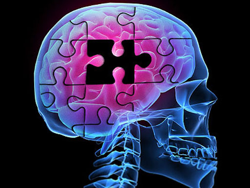 Enfermedad neurodegenerativa – Alzheimer