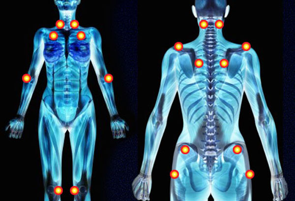 Fibromialgia: Una enfermedad que causa síntomas variados