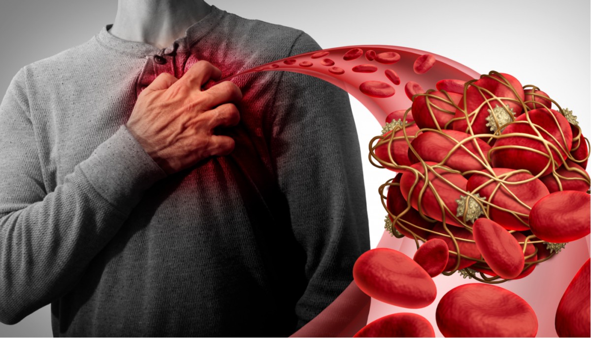 Las trombosis, una de las principales complicaciones en pacientes con COVID-19