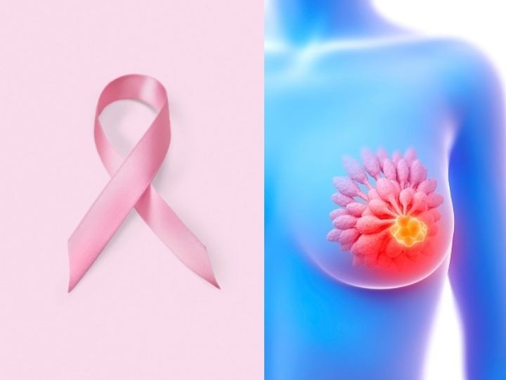 Salud; crean un algoritmo para la detección del cáncer de mama