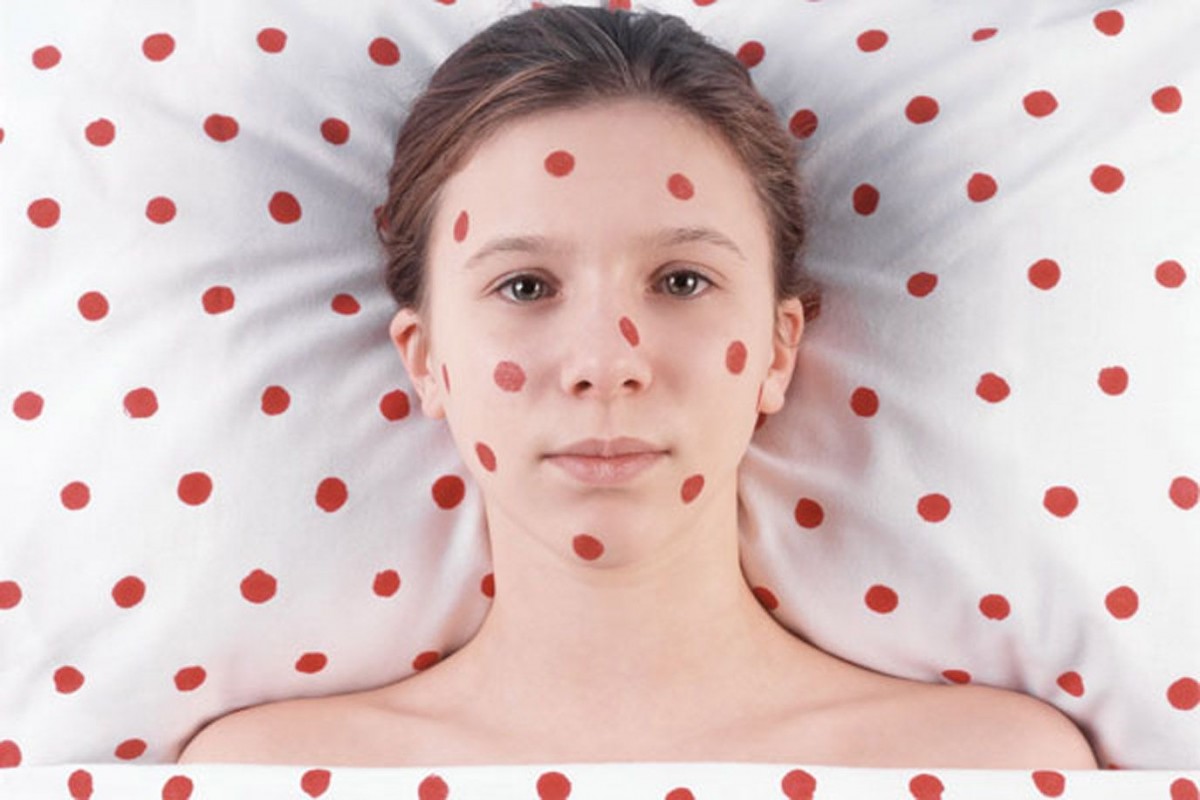 Sarampión y Covid-19: cuáles son los peligros de la caída en la tasa de vacunación