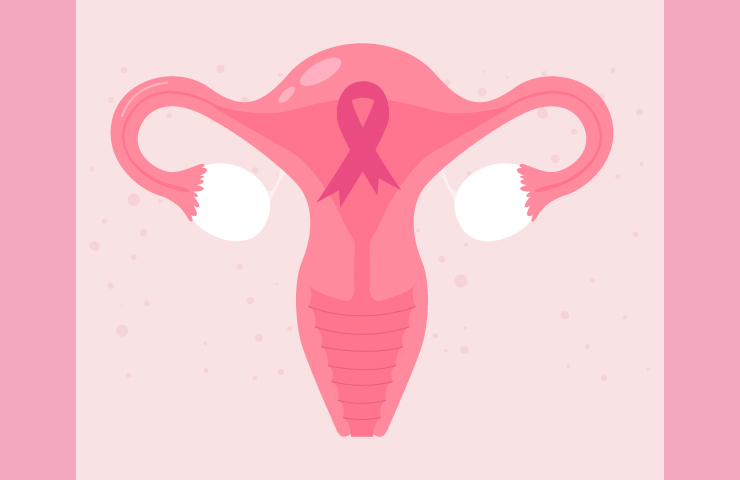 Salud: Día Mundial de Cáncer de cuello de útero, la enfermedad es que se suele desarrollar en forma silenciosa.